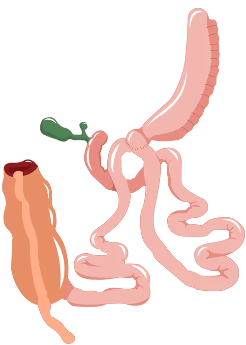 sadis surgery