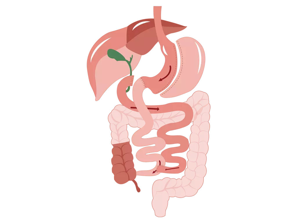 Post-Operative Diet Stages for Duodenal Switch (BPD/DS)